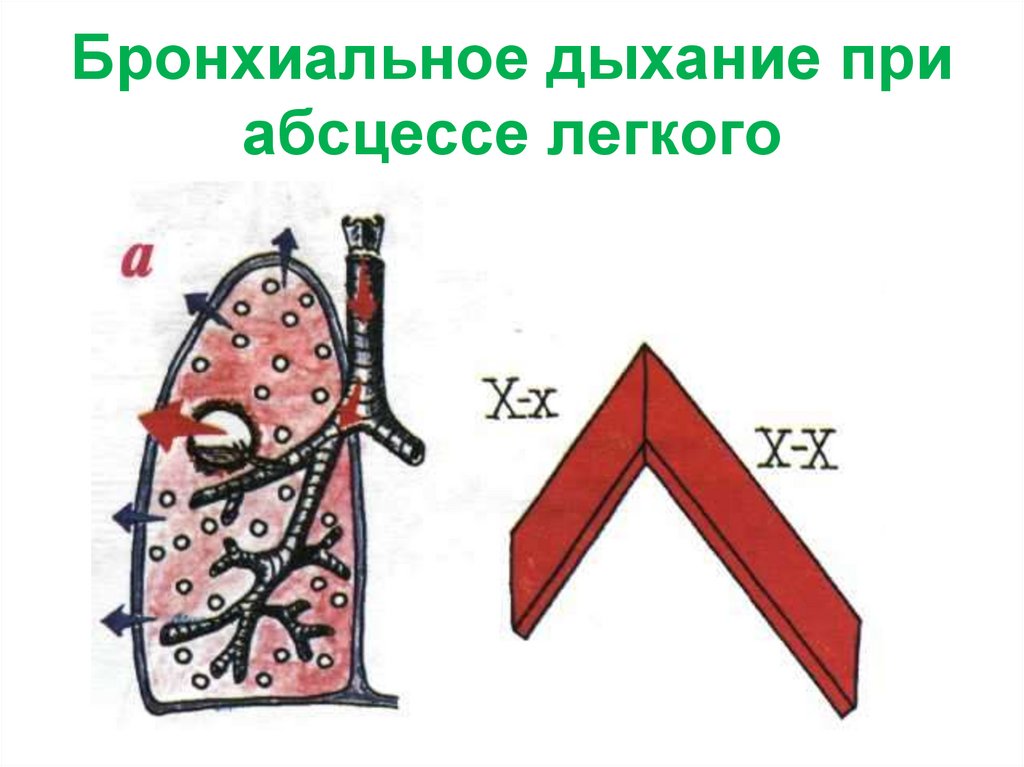 Бронхиальное дыхание при абсцессе легкого