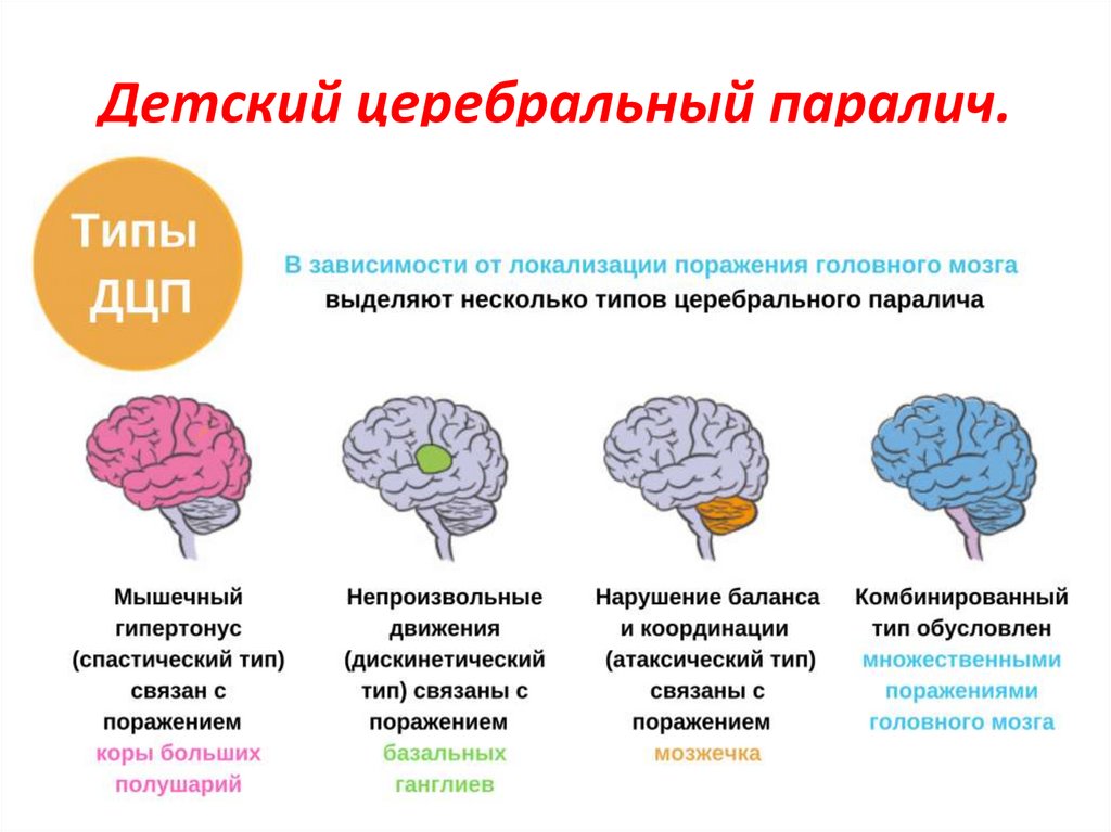 Детский церебральный паралич.