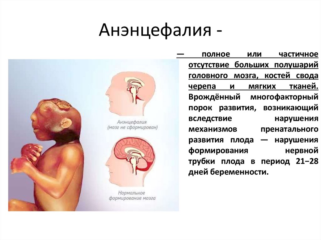 Анэнцефалия -