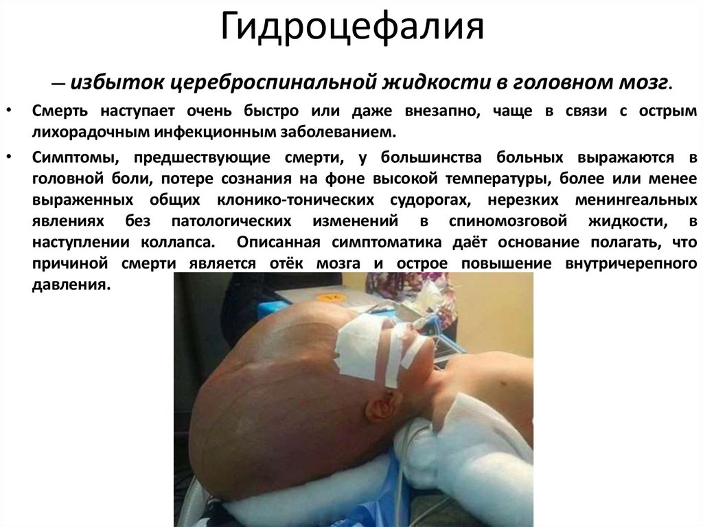 Гидроцефалия