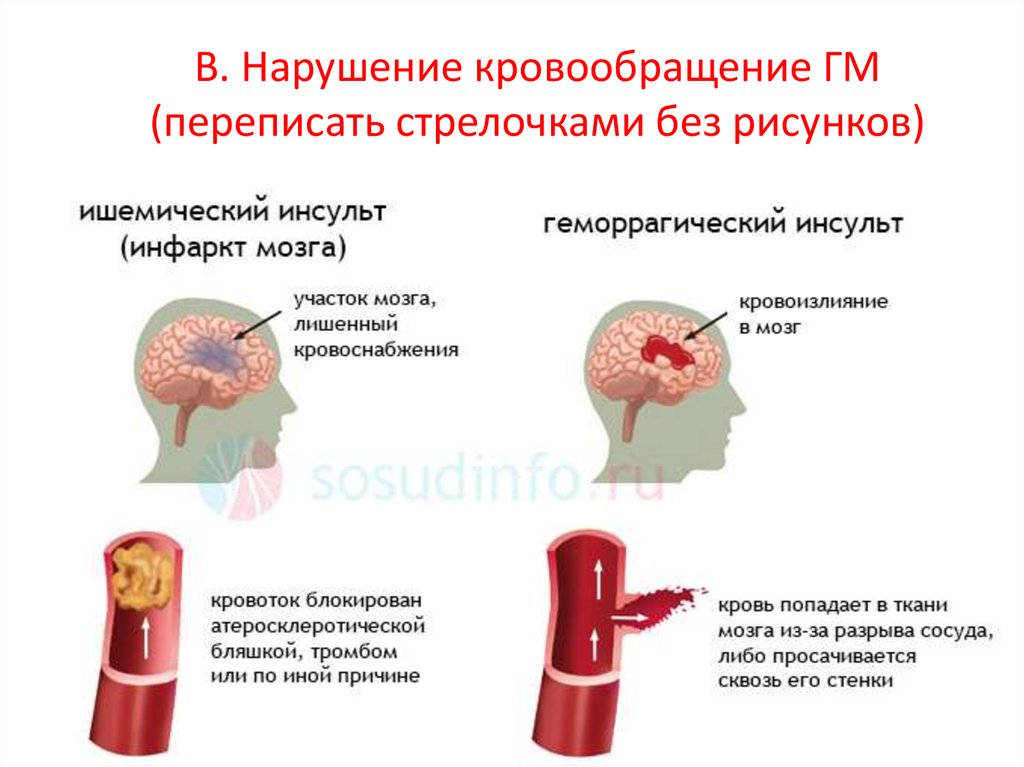 В. Нарушение кровообращение ГМ (переписать стрелочками без рисунков)