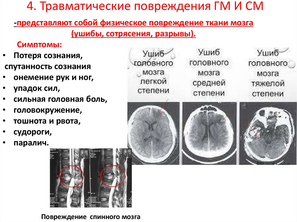 4. Травматические повреждения ГМ И СМ
