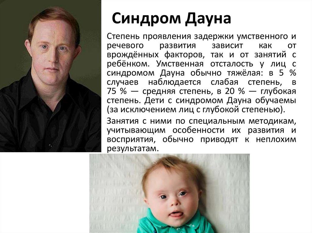 Синдром Дауна