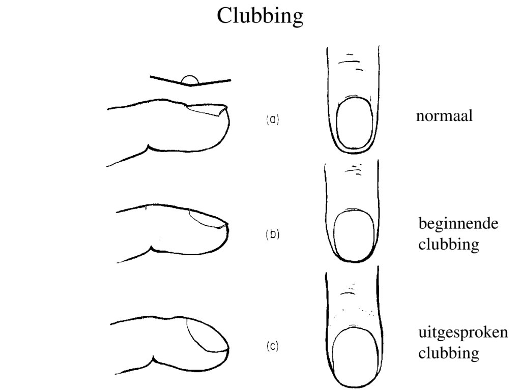 Clubbing