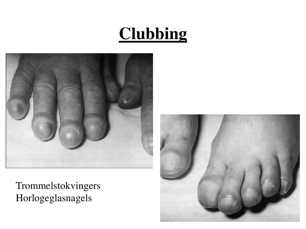 Clubbing