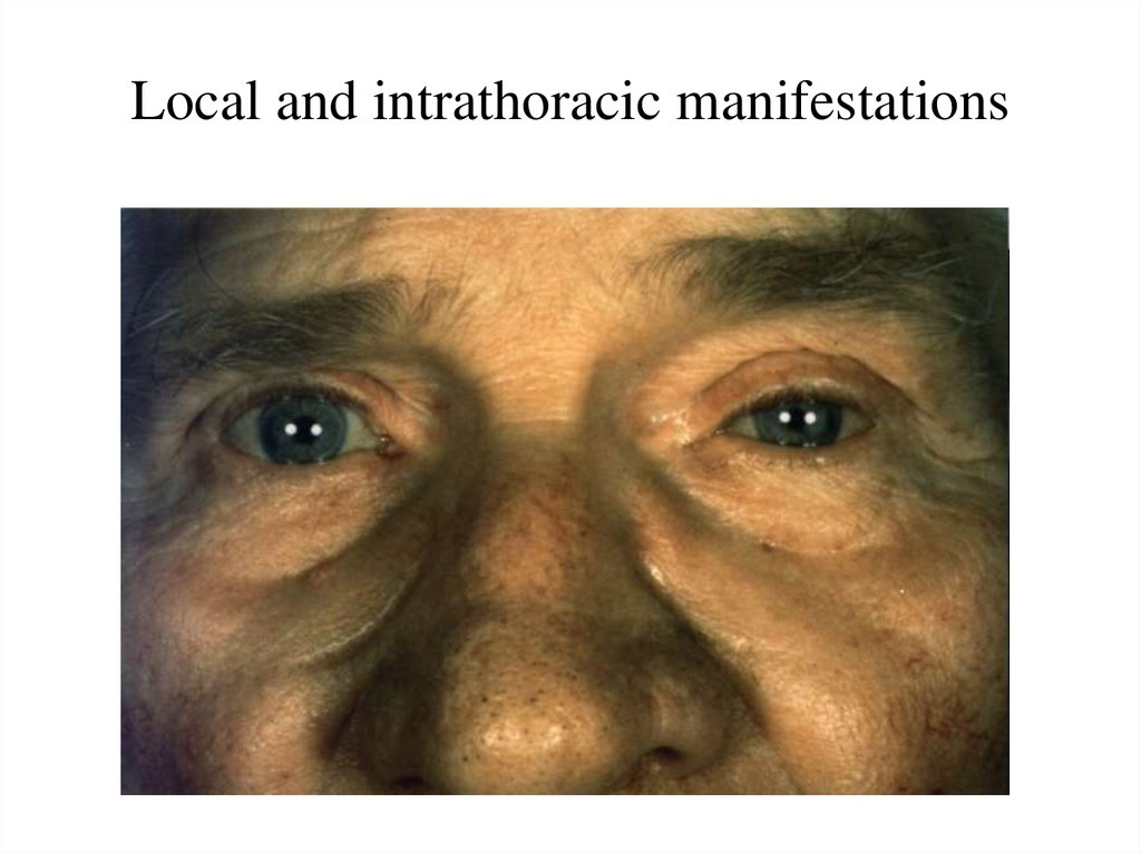 Local and intrathoracic manifestations
