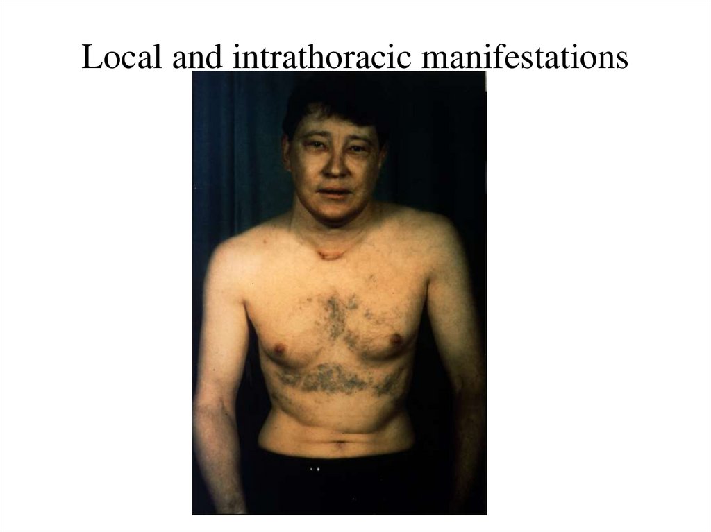 Local and intrathoracic manifestations