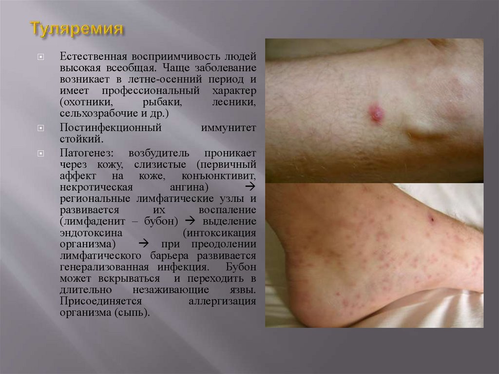 Туляремия (чумоподобная болезнь, малая чума, кроличья лихорадка)