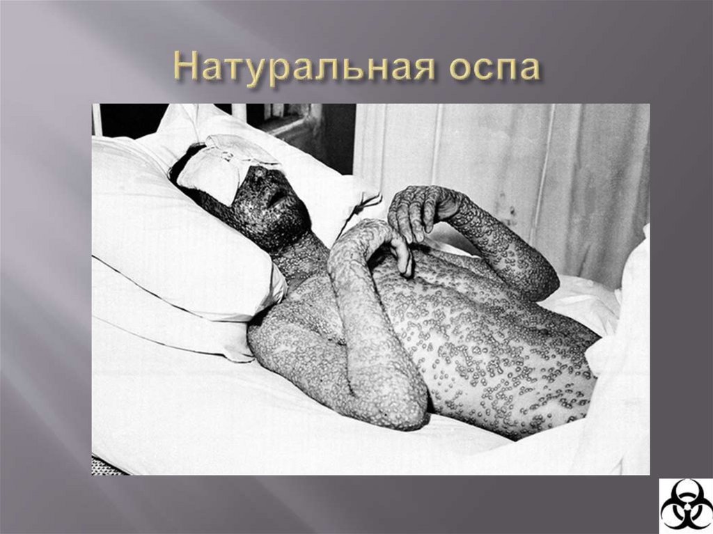 Натуральная оспа