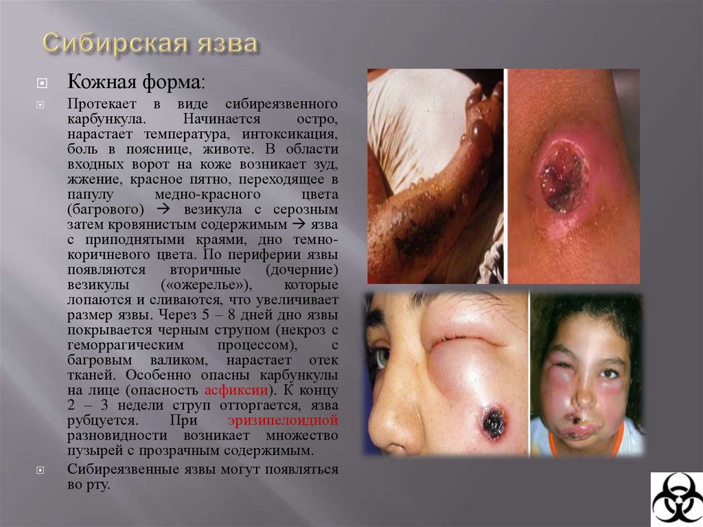 Сибирская язва