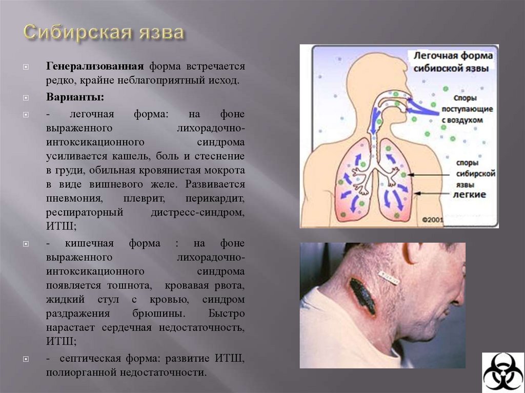 Сибирская язва