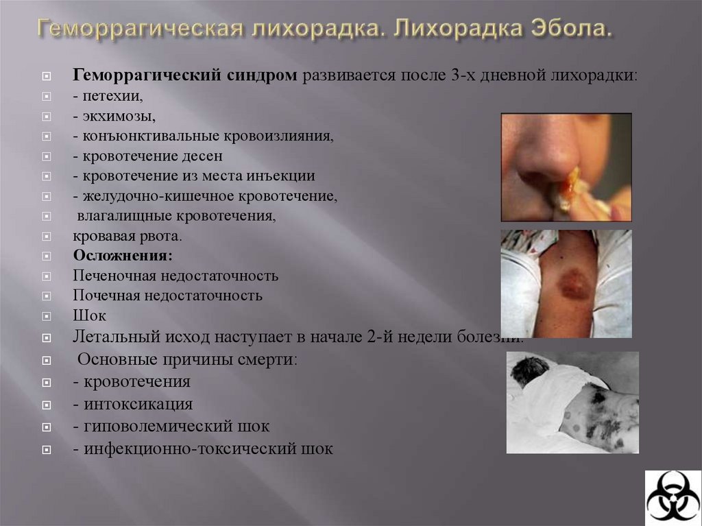 Геморрагические лихорадки. Лихорадка Эбола.