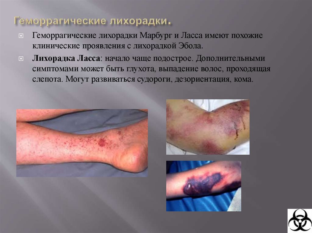 Геморрагическая лихорадка. Лихорадка Эбола.