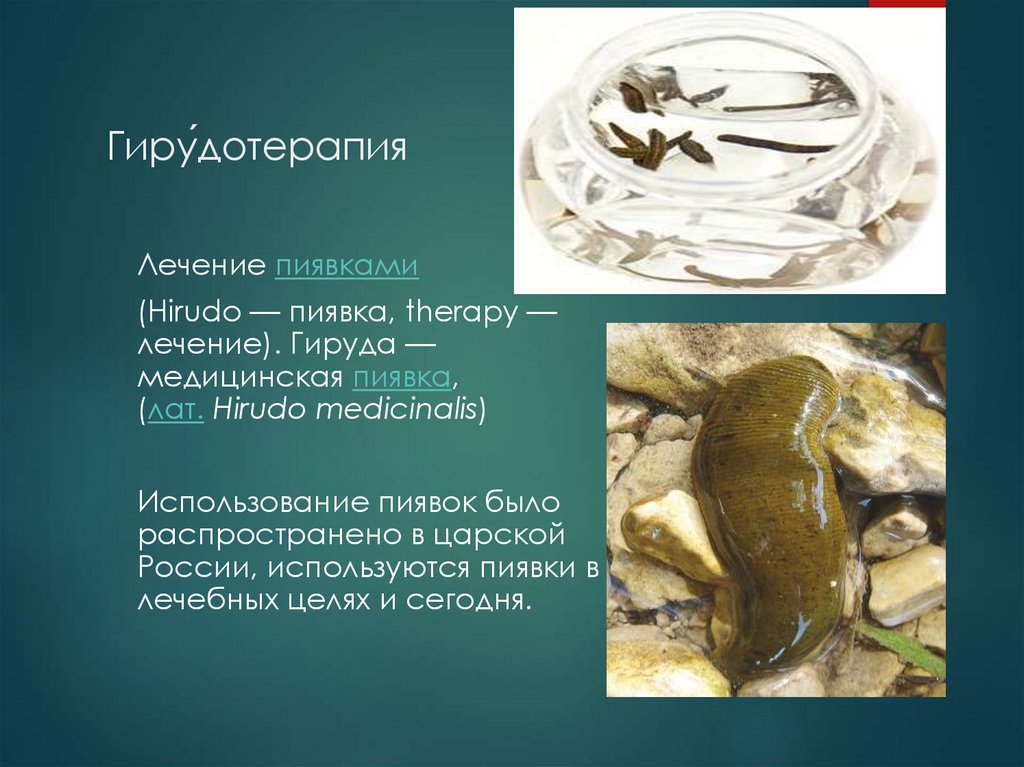 Гиру́дотерапия