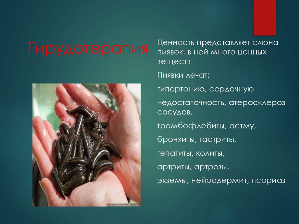 Гирудотерапия