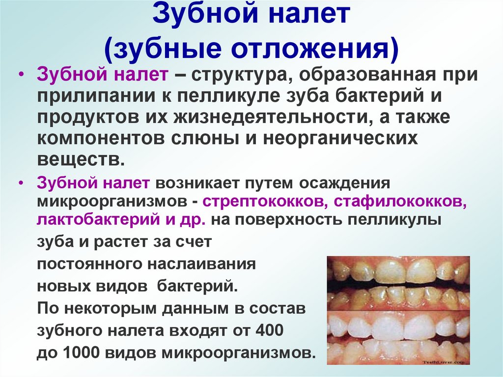 Зубной налет (зубные отложения)