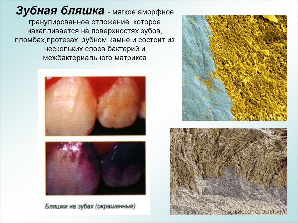 Зубная бляшка - мягкое аморфное гранулированное отложение, которое накапливается на поверхностях зубов, пломбах,протезах,