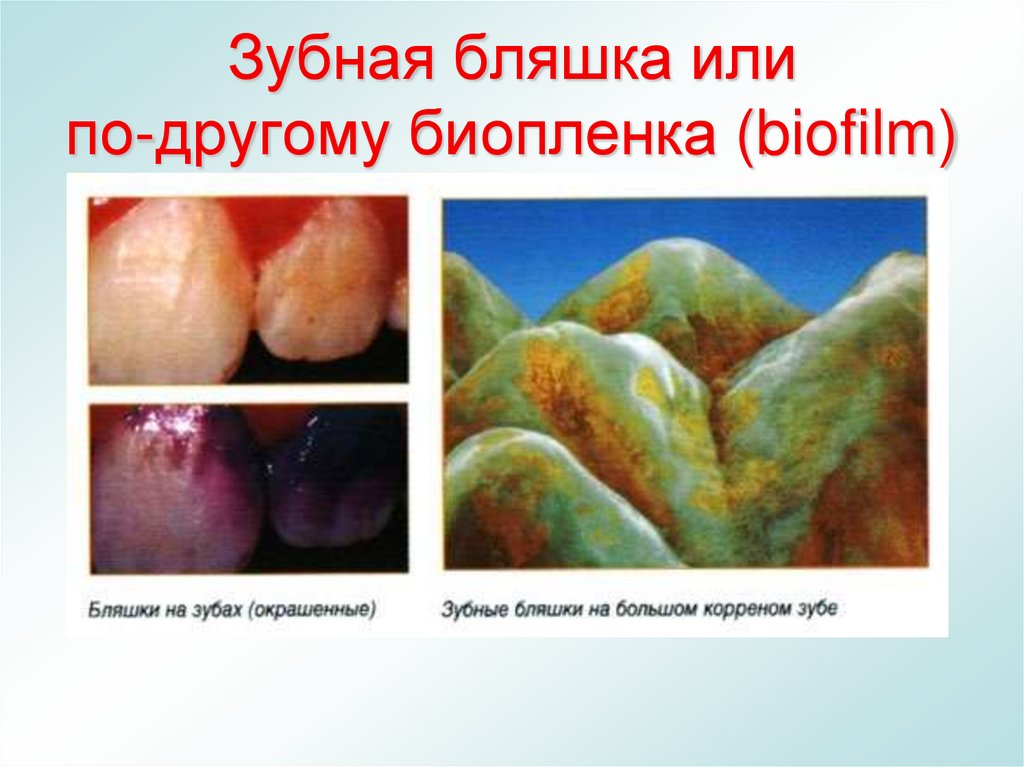 Зубная бляшка или по-другому биопленка (biofilm)