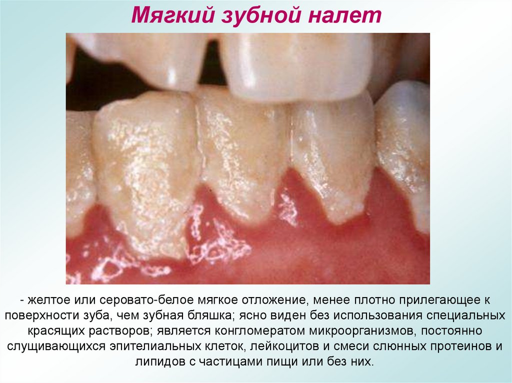 Мягкий зубной налет