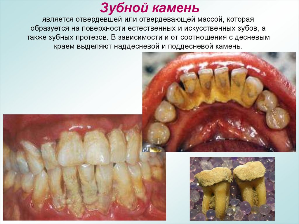 Зубной камень