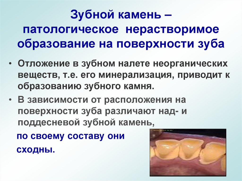 Зубной камень – патологическое нерастворимое образование на поверхности зуба