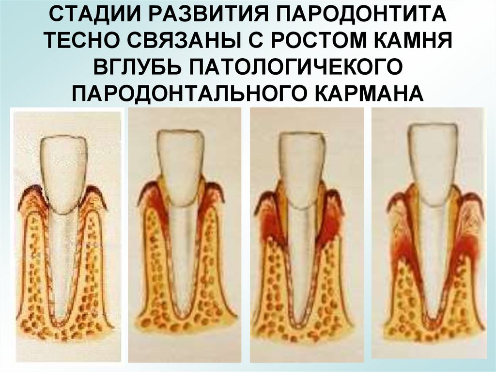 СТАДИИ РАЗВИТИЯ ПАРОДОНТИТА ТЕСНО СВЯЗАНЫ С РОСТОМ КАМНЯ ВГЛУБЬ ПАТОЛОГИЧЕКОГО ПАРОДОНТАЛЬНОГО КАРМАНА