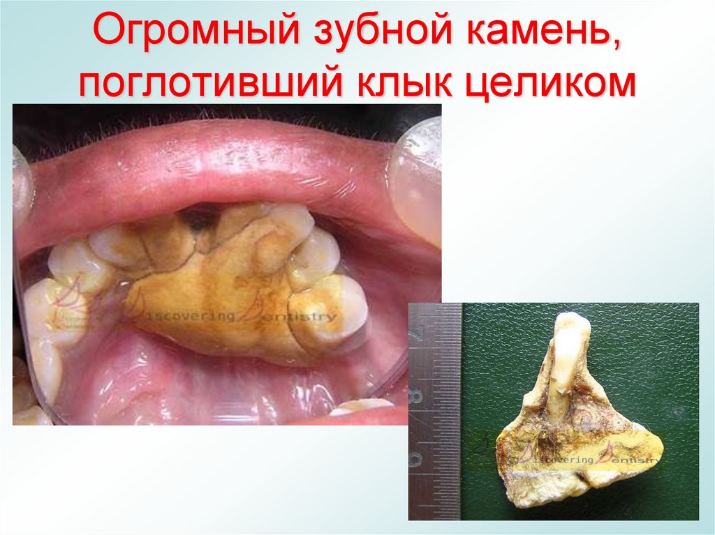 Огромный зубной камень, поглотивший клык целиком