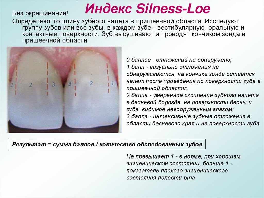 Индекс Silness-Loe