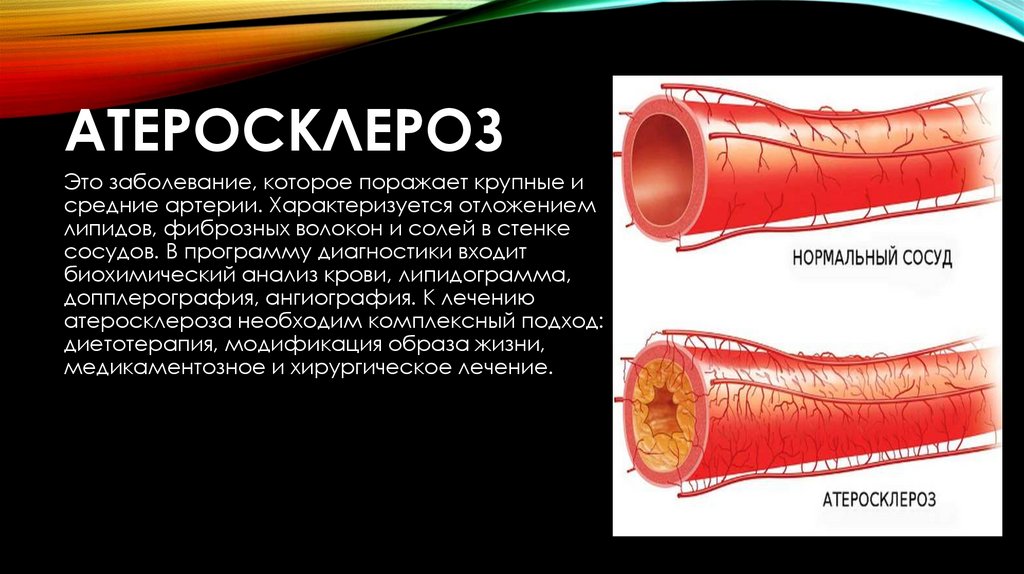 Атеросклероз