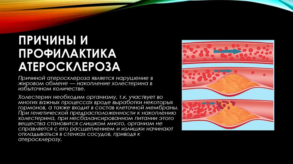 Причины и профилактика атеросклероза