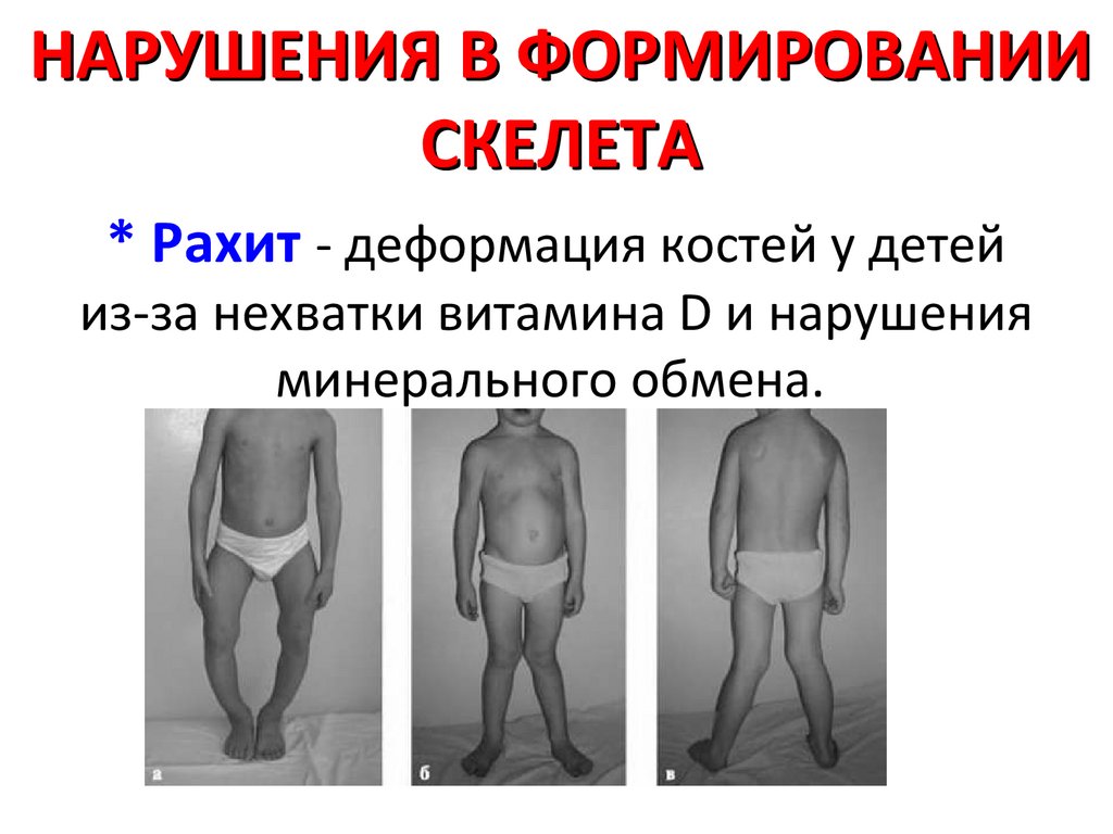 НАРУШЕНИЯ В ФОРМИРОВАНИИ СКЕЛЕТА