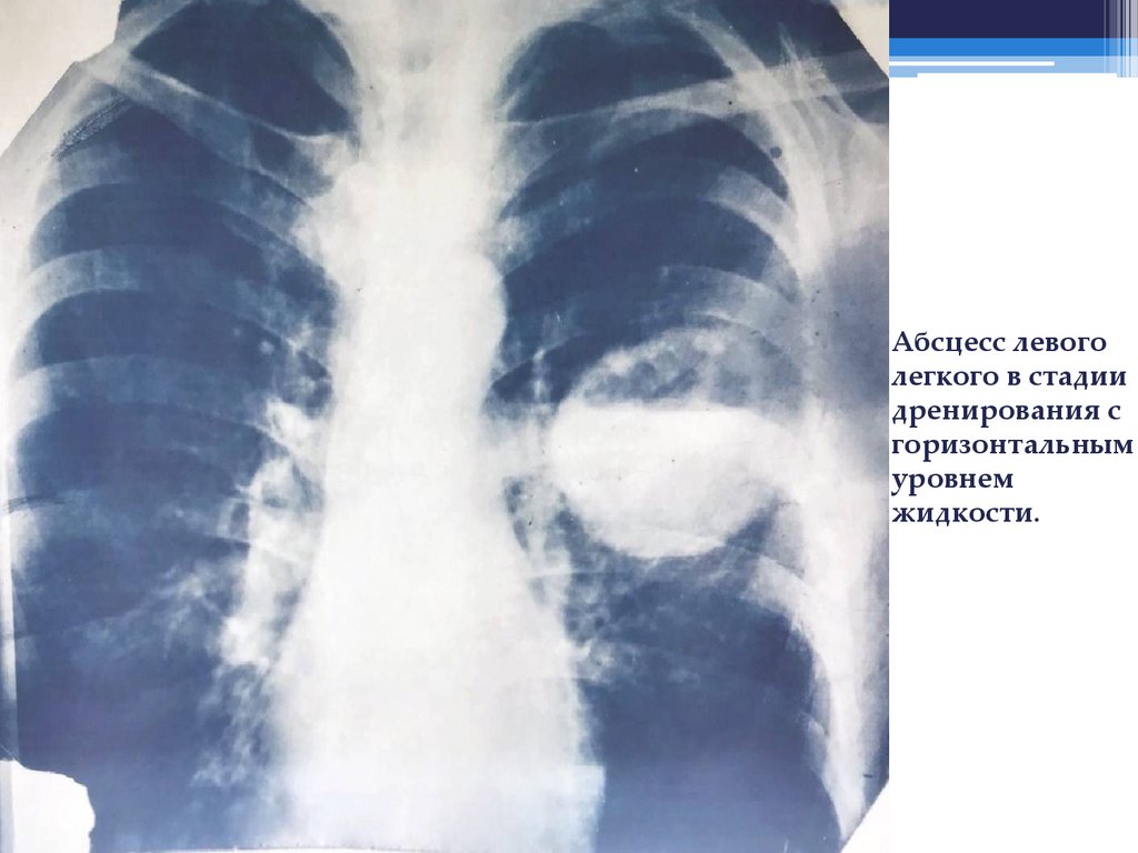 Абсцесс левого легкого в стадии дренирования с горизонтальным уровнем жидкости.