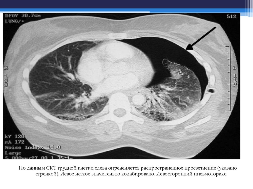 Пневмоторакс