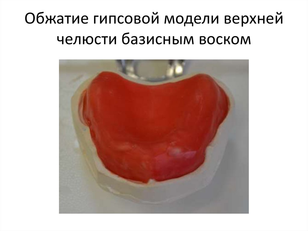 Обжатие гипсовой модели верхней челюсти базисным воском