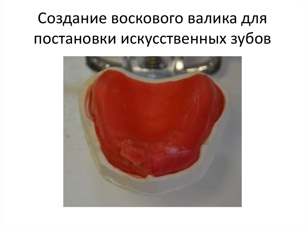 Создание воскового валика для постановки искусственных зубов