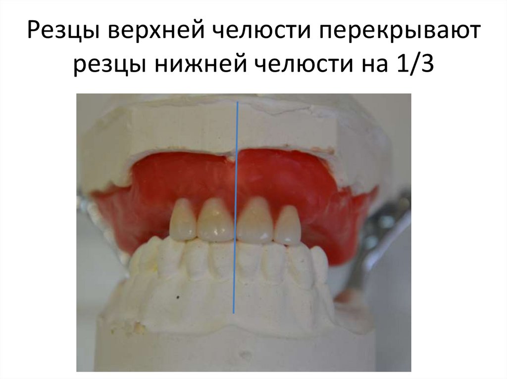 Резцы верхней челюсти перекрывают резцы нижней челюсти на 1/3