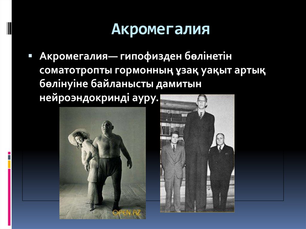 Акромегалия