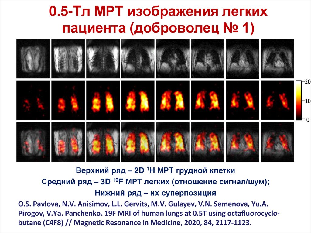 0.5-Tл МРТ изображения легких пациента (доброволец № 1)