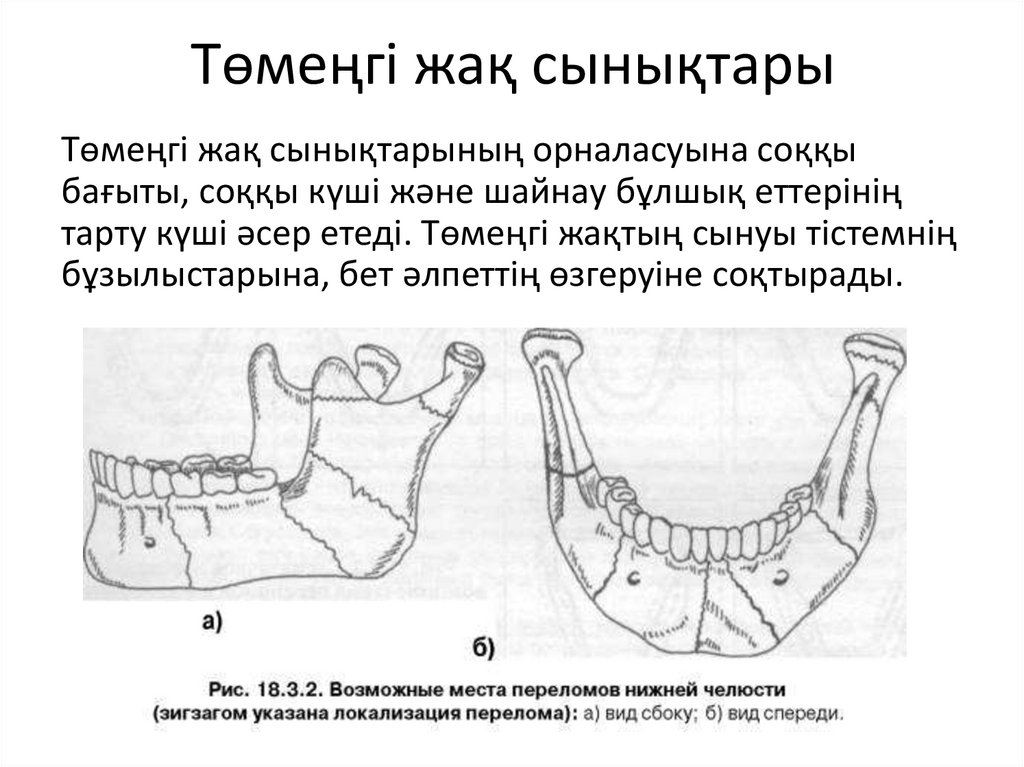 Төмеңгі жақ сынықтары