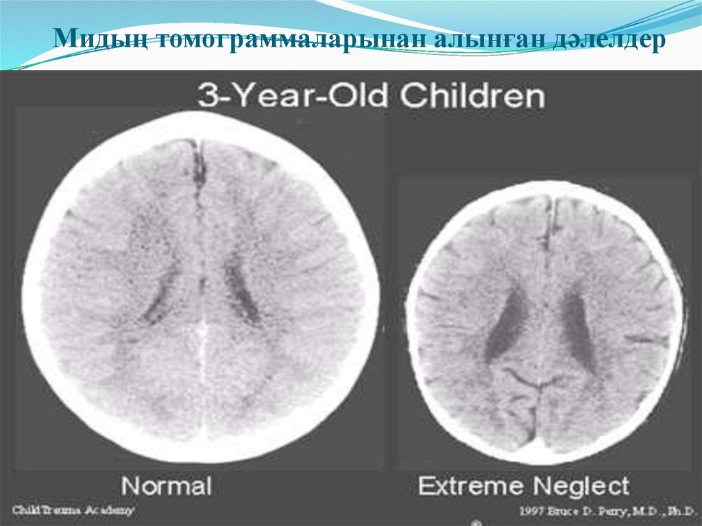 Мидың томограммаларынан алынған дәлелдер