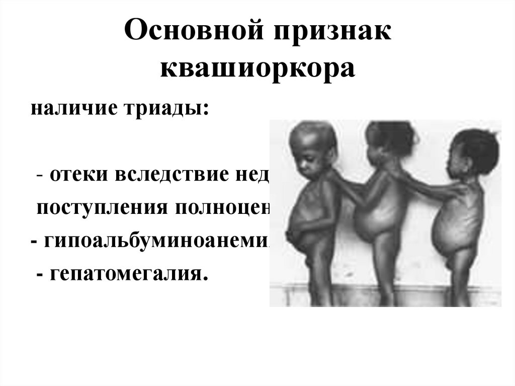 Основной признак квашиоркора
