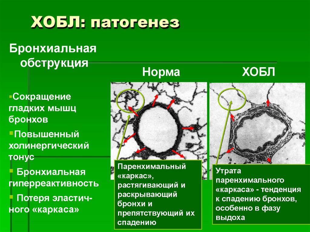 ХОБЛ: патогенез