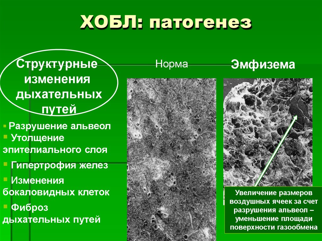 ХОБЛ: патогенез