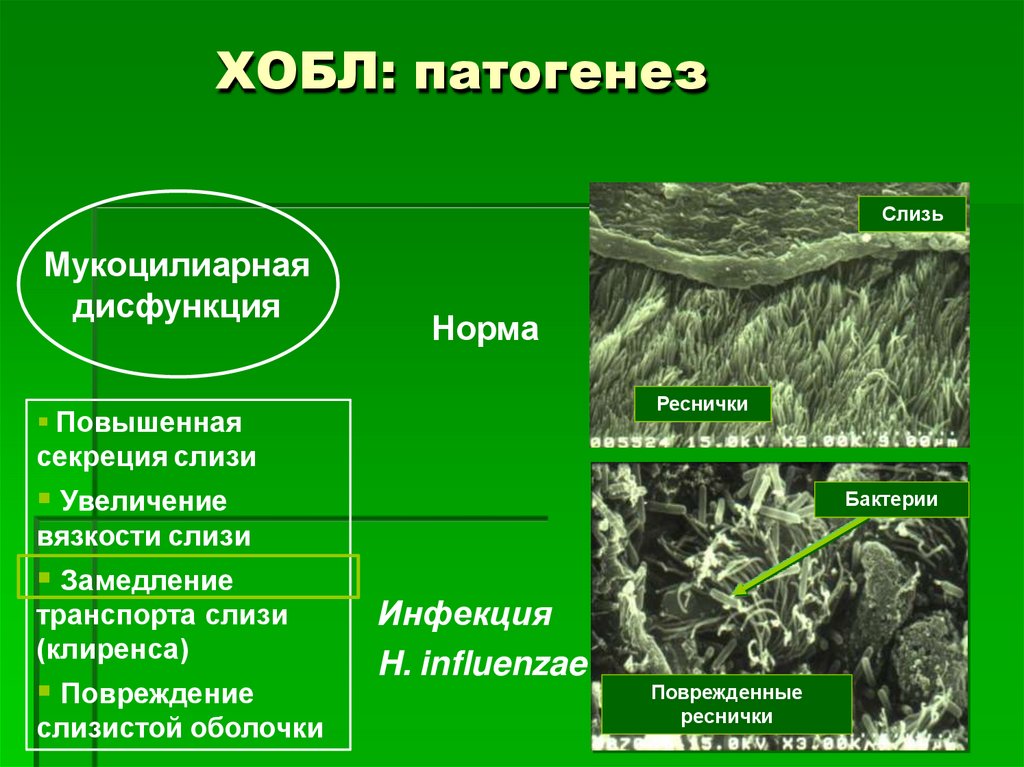 ХОБЛ: патогенез