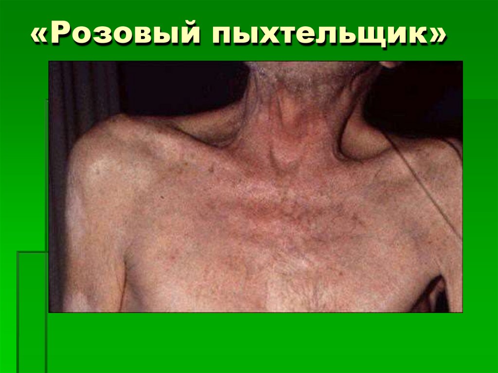 «Розовый пыхтельщик»