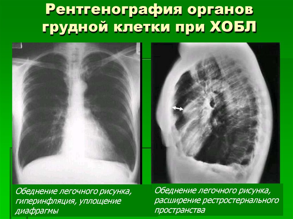 Рентгенография органов грудной клетки при ХОБЛ