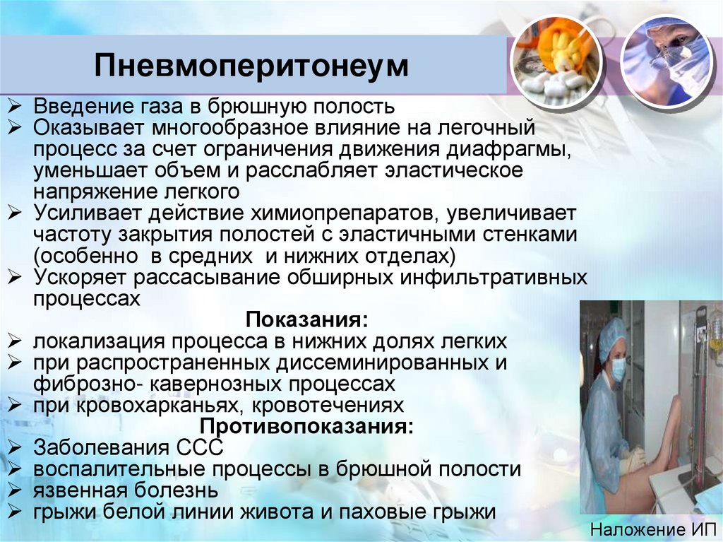 Пневмоперитонеум