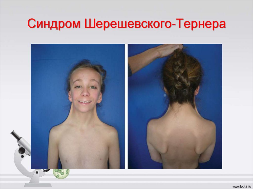 Синдром Шерешевского-Тернера