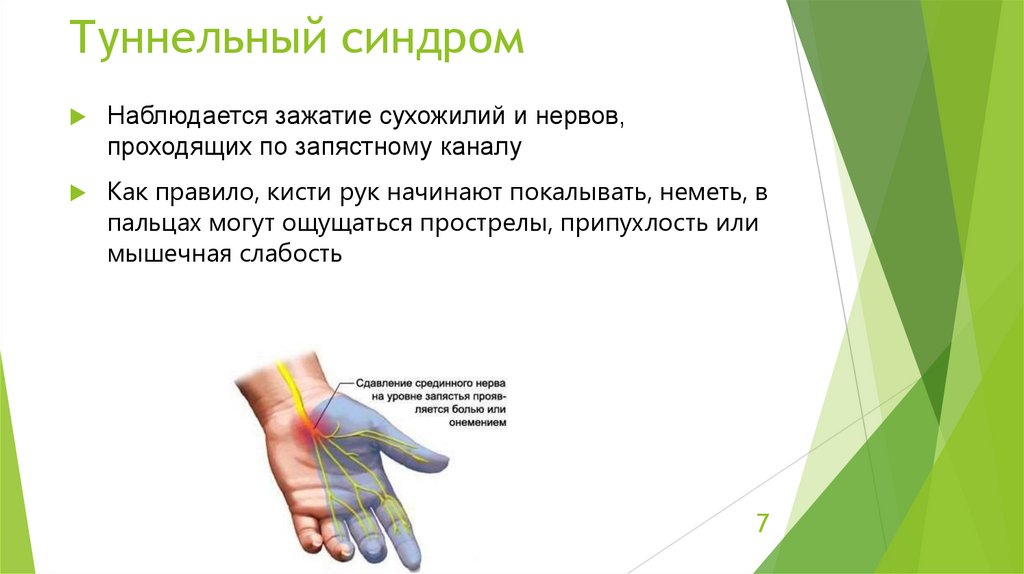 Туннельный синдром