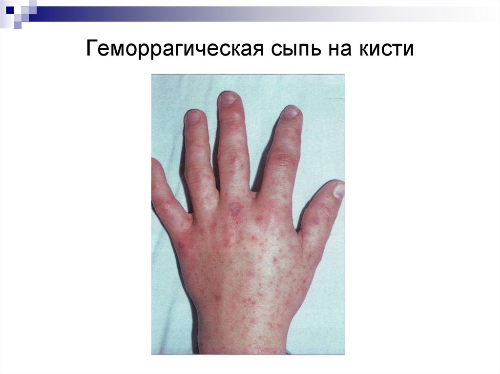 Геморрагическая сыпь на кисти
